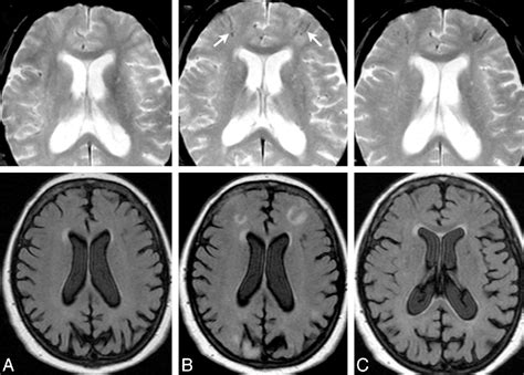 Figure From Mr Imaging Features Of Amyloid Related Imaging