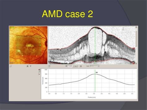 How 3 d oct enhances amd & dme treatment