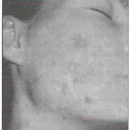 Inflamed sores in the face of El, a female from Norway born in 1971,... | Download Scientific ...