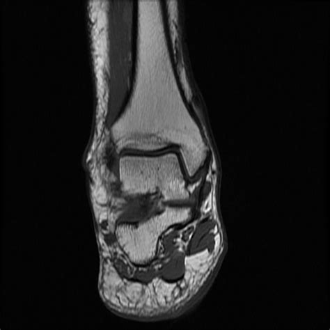 Anterior Ankle Impingement Image