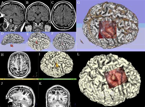 Distribution probability map of lesions within central sulcus or ...