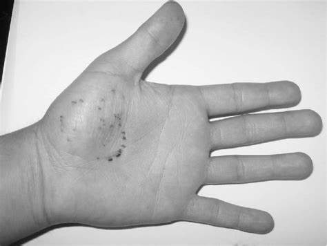 Left Hand Of Patient 10 Days After The Bite Download Scientific Diagram