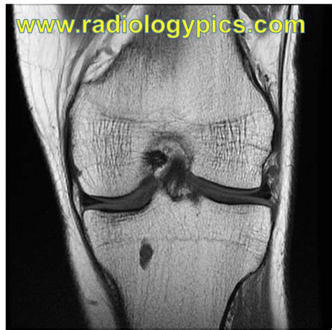 Unknown Case 29 Knee MRI RADIOLOGYPICS