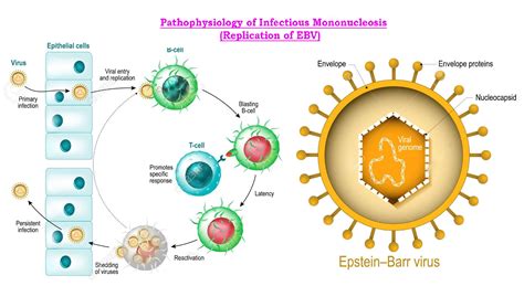 Infectious mononucleosis - MedicoInfo