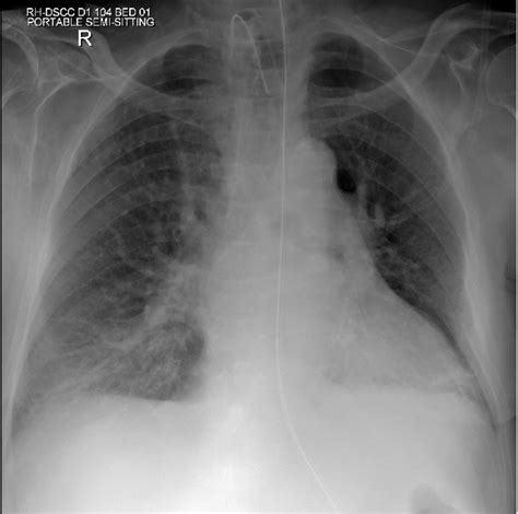 Chest X Ray Showing Nasogastric Tube And Tracheostomy Tube With No