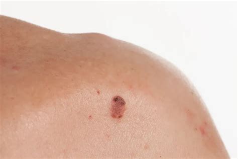 All About Basal Cell Carcinoma Understanding The Most Common Skin