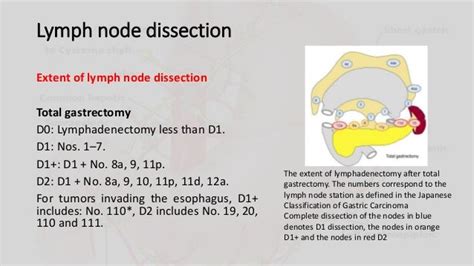 Management Of Metastatic Lymph Nodes In Gastric Cancer