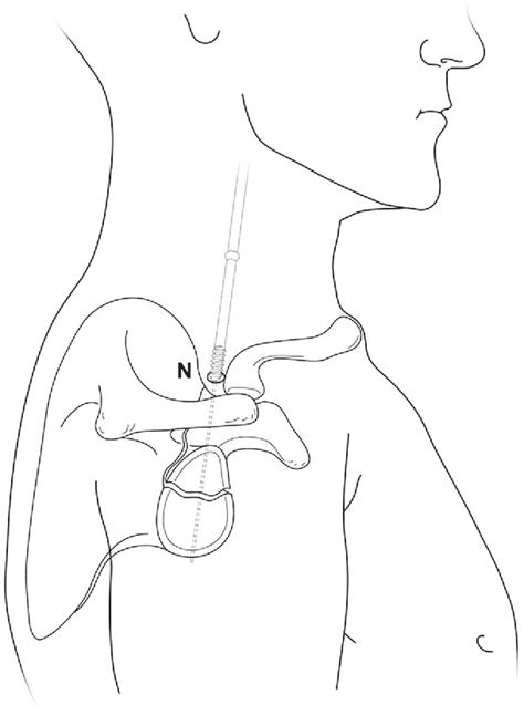 Figure 3 From Arthroscopic Assisted Reduction And Percutaneous