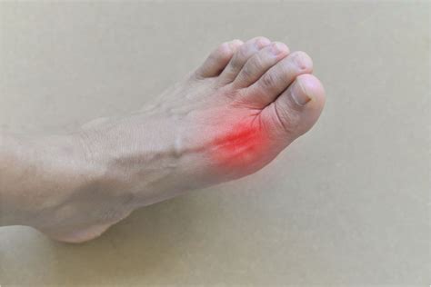 Gout Crystals: What Are They and Can They Be Removed? - Alpha Nutrition