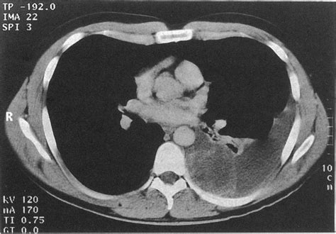 chest radiograph  initial   scientific diagram