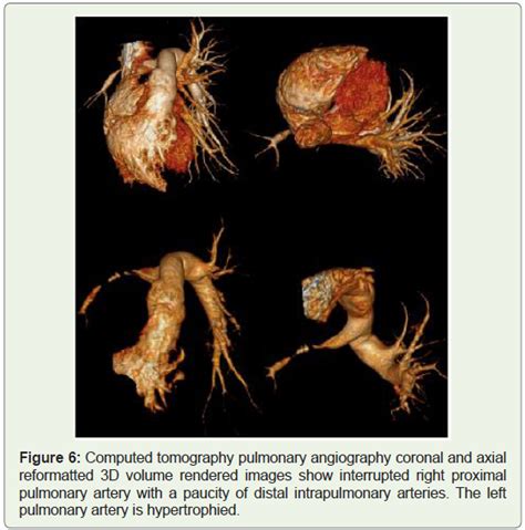 A Rare Case Of Isolated Proximal Interruption Of The Right Pulmonary Artery