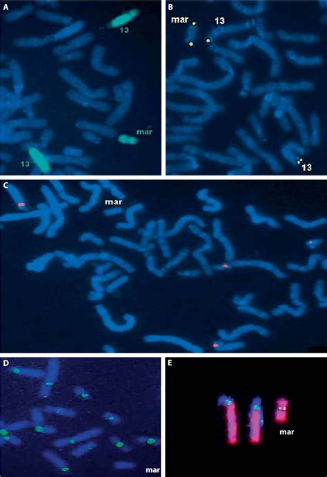 Table 1 From First Prenatally Detected Small Supernumerary Neocentromeric Derivative Chromosome