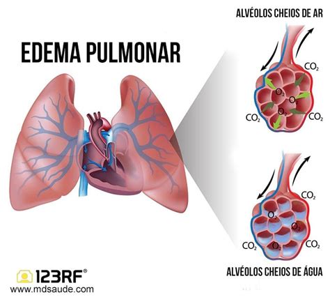 EDEMA PULMONAR AGUDO Sintomas Causas e Tratamento MD Saúde