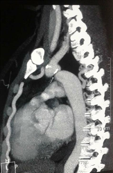 Ct Angiography Showing Coarctation Of Aorta Download Scientific Diagram