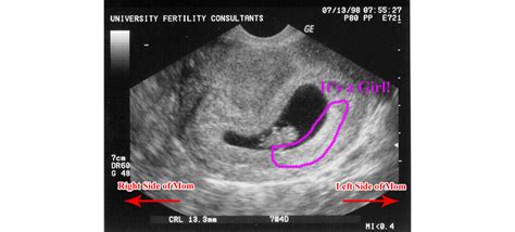 Baby At 8 Weeks Ultrasound - All You Need Infos