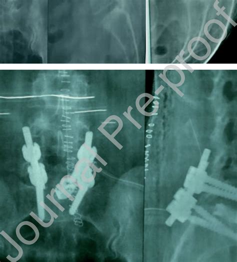 A B 55 Years Female Radiographs Of Lumbosacral Spine Download