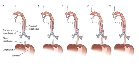 Tracheoesophageal Fistula Types