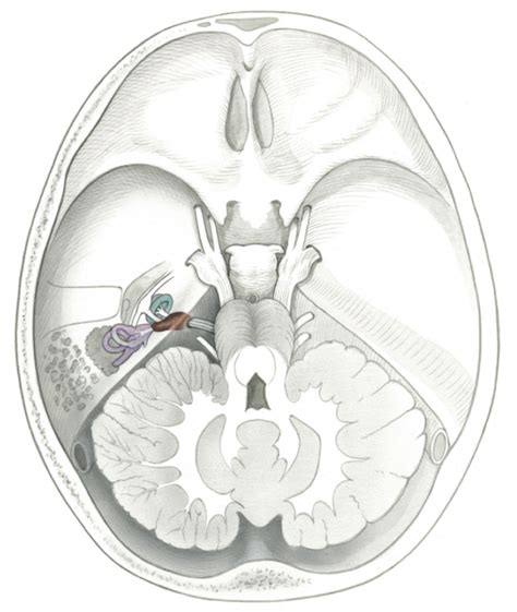 Acoustic Neuroma Skull Base Surgery Stanford Medicine