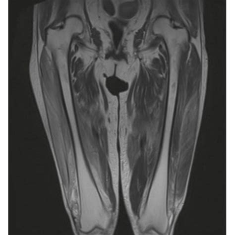 Magnetic resonance imaging (MRI) of bilateral thigh muscles of a woman... | Download Scientific ...