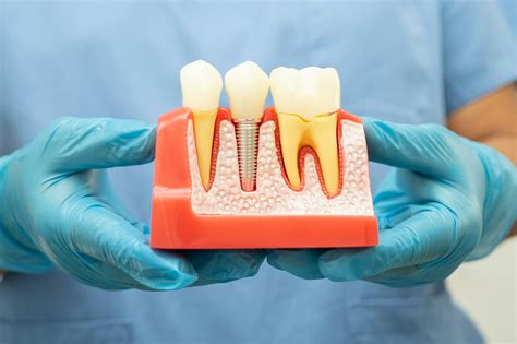 Dental Services In St Louis Schlueter Periodontics Implants