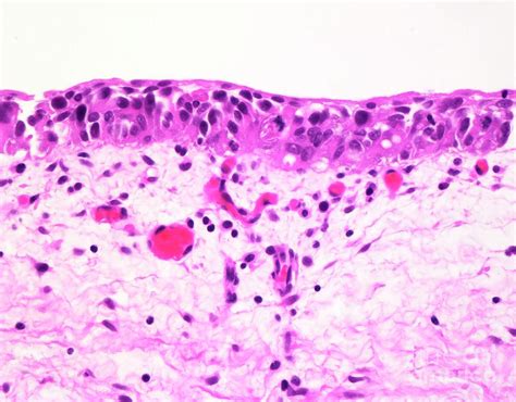 Urothelial Carcinoma In Situ Photograph By Webpathologyscience Photo Library