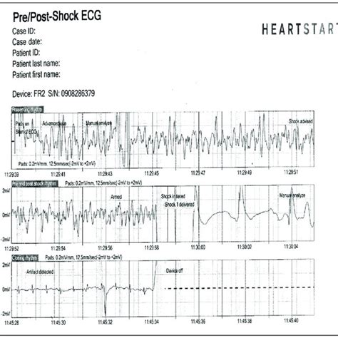 The Eeg Recording Showed Alpha Activity Normal Cardiac Rhythm And