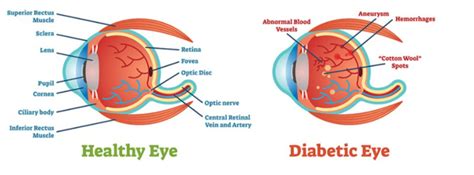 Diabetic Eye Exam Boerne Vision Center