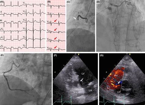 A A 12 Lead Electrocardiogram B An Electrocardiogram In Right