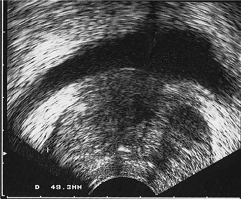 Transrectal Ultrasonographic Measurement Of Prostate Dimensions By