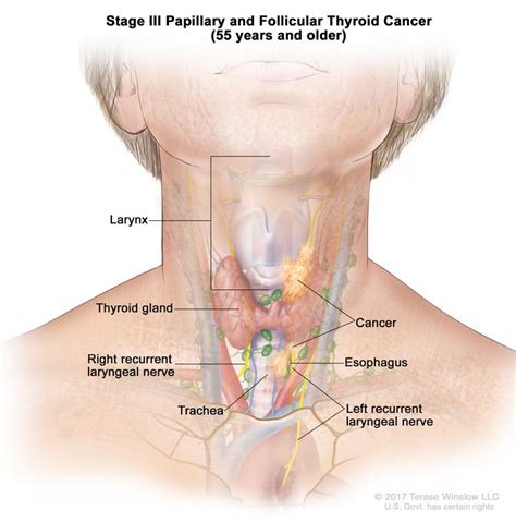 Thyroid Cancer Treatment Pdq®patient Version Nci