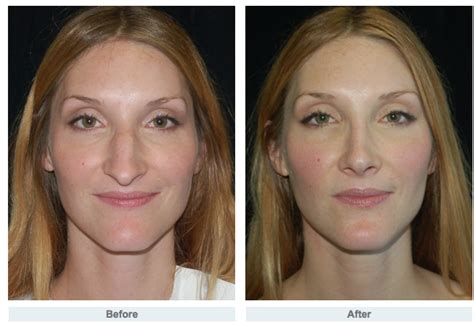 Rhinoplasty Journey Dr Gary Motykie Beverly Hills