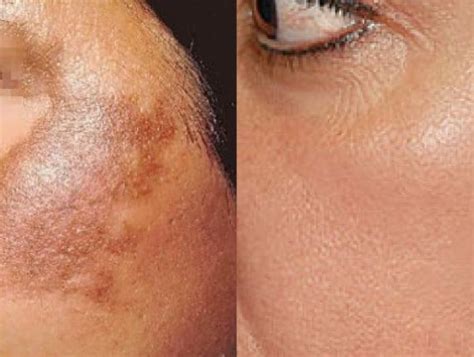 Laser For Pigmentation Removal Insight Derma Clinic