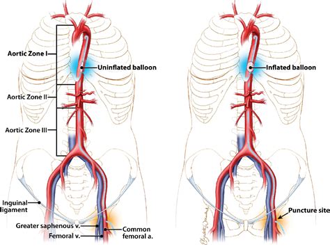 Figure 1 From Vascular Access Training For Resuscitative Endovascular