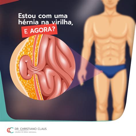 O Que Causa Hérnia Na Virilha