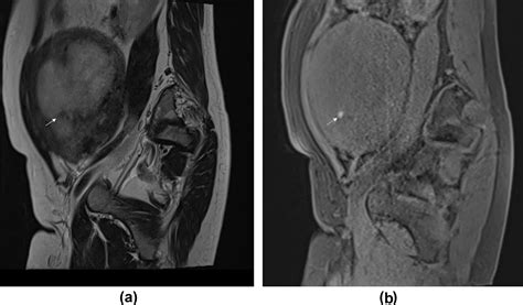 The Role Of Multiparametric Mri In Differentiating Uterine