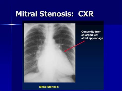 PPT - Valvular Heart Disease PowerPoint Presentation - ID:443921