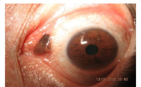 Conjunctival Nevus At Semilunar Plica Foto Alena Furdova Department