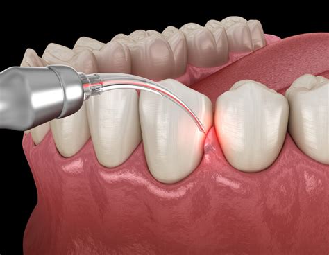 Gums Procedure