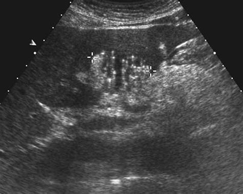 Liver Abscess Ultrasound