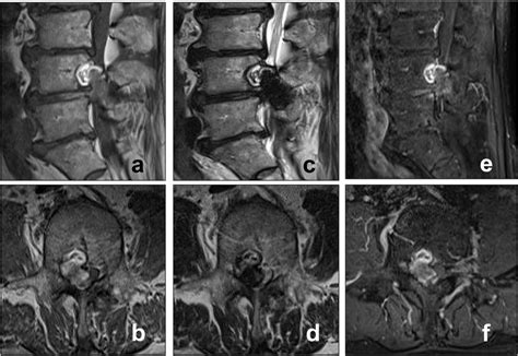 Magnetic Resonance Imaging Mri Findings A T1 Weighted Mri Sagittal