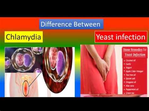 Difference Between Chlamydia And Yeast Infection YouTube