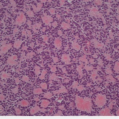 Ewing S Sarcoma Showing Uniform Small Cells With Round Nuclei And Fine