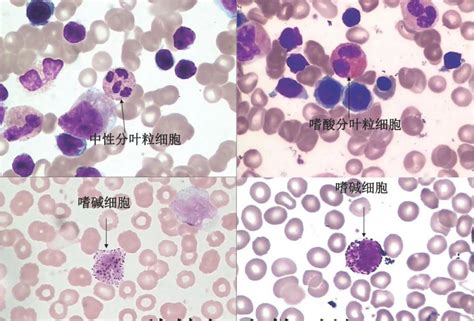 汇总！118张血细胞典型形态学图谱形态学图谱胞浆细胞泡沫状 健康界