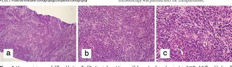 Figure 2 From Breast Recurrence Of Acute Myeloid Leukemia After Bone