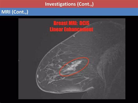 Ductal Carcinoma In Situ Dcis Ppt