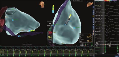 Ventricular Tachycardia 2 Termination With Radiofrequency Energy And Download Scientific