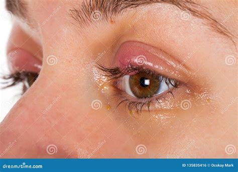 Upper Eyelid Infection Chalazion Stock Photo Image Of Inflammation