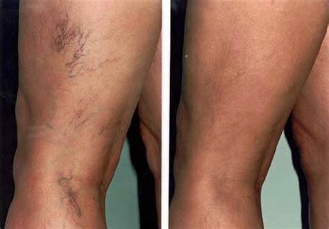 Laser For Spider Veins Radin Skin Centre