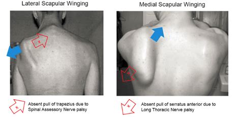 Scapular Winging