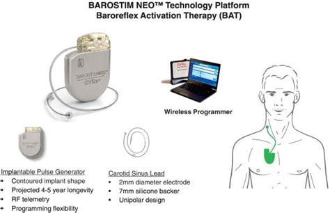 Barostim New Device To Treat Heart Failure Have You Heard About It